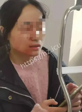 女教师劝架被戳伤眼球